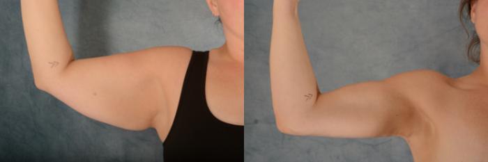 Before & After Arm Lift (Brachioplasty) Case 601 Front View in Tallahassee, FL