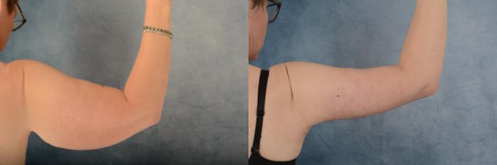 Before & After Arm Lift (Brachioplasty) Case 621 Back View in Tallahassee, FL