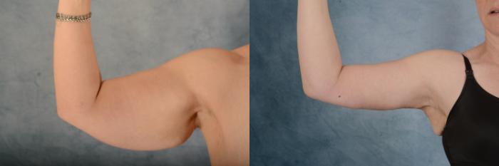 Before & After Arm Lift (Brachioplasty) Case 621 Front View in Tallahassee, FL