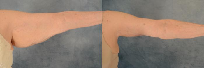 Before & After Arm Lift (Brachioplasty) Case 623 Front View in Tallahassee, FL