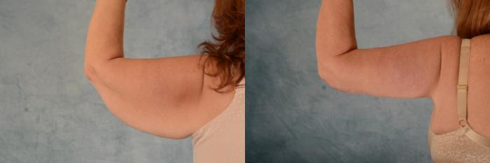 Before & After Arm Lift (Brachioplasty) Case 626 Back View in Tallahassee, FL