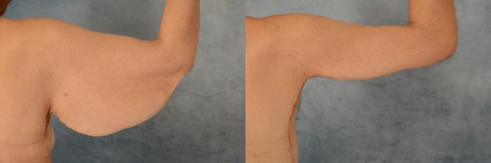 Before & After Arm Lift (Brachioplasty) Case 636 Back View in Tallahassee, FL
