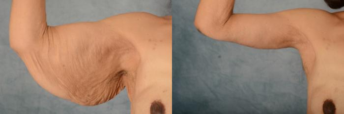Before & After Arm Lift (Brachioplasty) Case 636 Front View in Tallahassee, FL