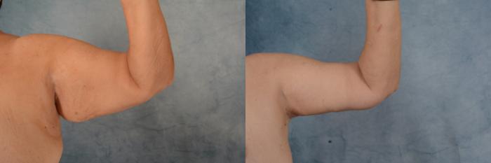 Before & After Arm Lift (Brachioplasty) Case 637 Left Side View in Tallahassee, FL