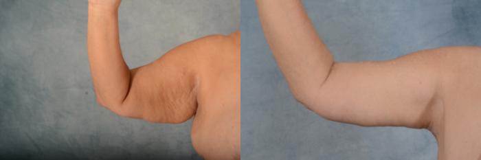 Before & After Arm Lift (Brachioplasty) Case 637 Right Side View in Tallahassee, FL