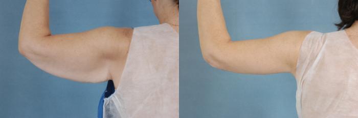 Before & After Arm Lift (Brachioplasty) Case 641 Back View in Tallahassee, FL