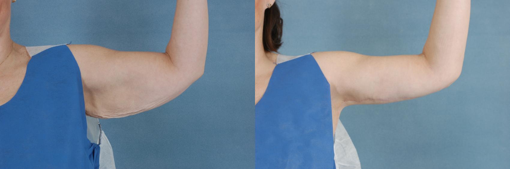 Before & After Arm Lift (Brachioplasty) Case 641 Front View in Tallahassee, FL