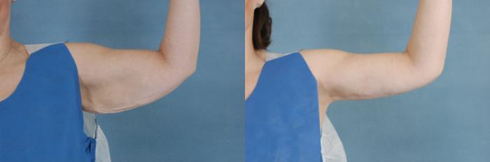 Before & After Arm Lift (Brachioplasty) Case 641 Front View in Tallahassee, FL