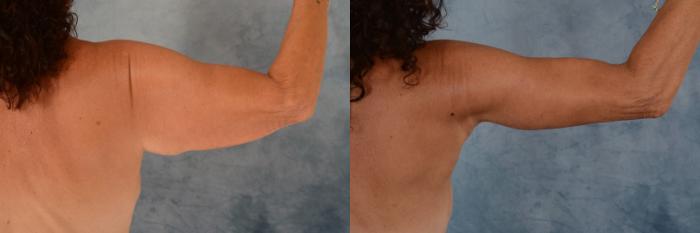 Before & After Arm Lift (Brachioplasty) Case 656 Left Side View in Tallahassee, FL