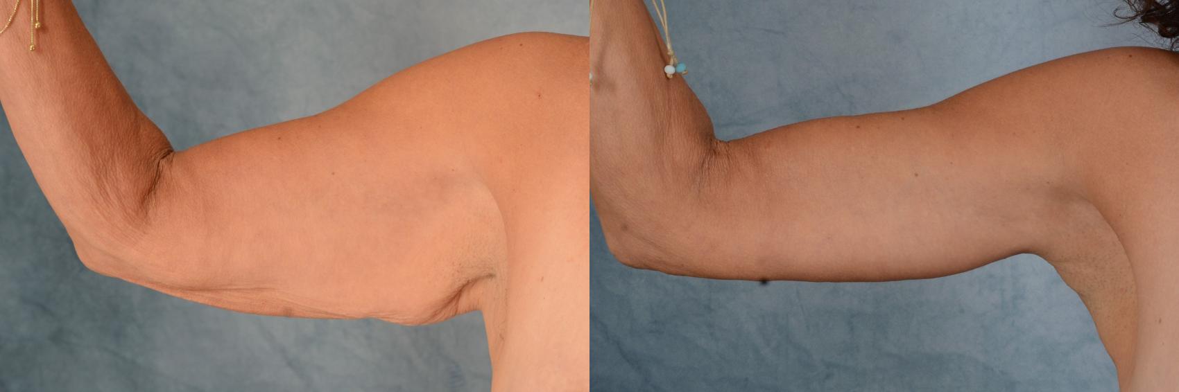 Before & After Arm Lift (Brachioplasty) Case 656 Right Arm, Front View View in Tallahassee, FL