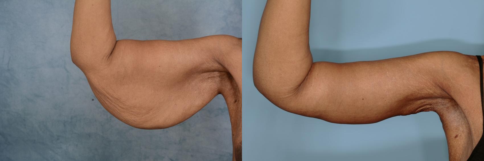 Before & After Arm Lift (Brachioplasty) Case 659 Right Side View in Tallahassee, FL