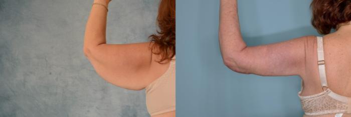 Before & After Arm Lift (Brachioplasty) Case 671 Right Side View in Tallahassee, FL