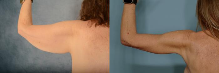 Before & After Arm Lift (Brachioplasty) Case 686 Back View in Tallahassee, FL