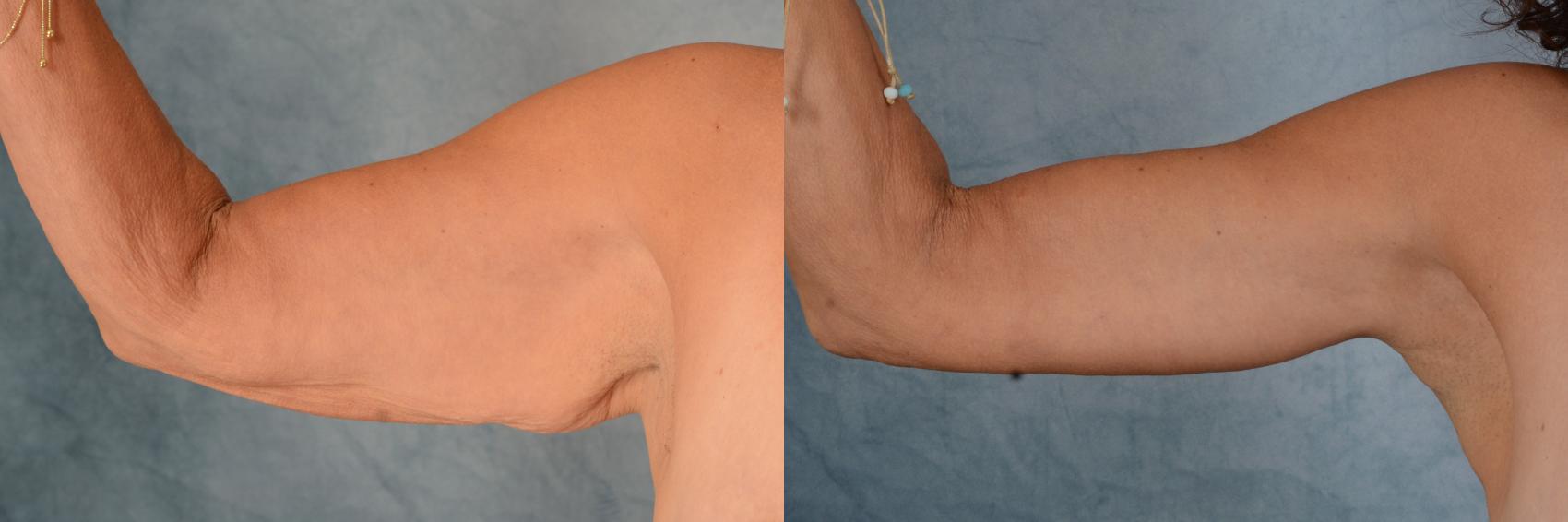 Before & After Arm Lift (Brachioplasty) Case 693 Front View in Tallahassee, FL