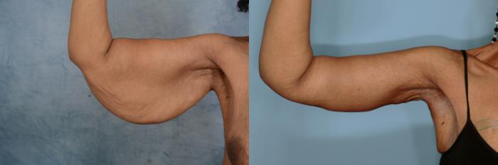 Before & After Arm Lift (Brachioplasty) Case 704 Front View in Tallahassee, FL