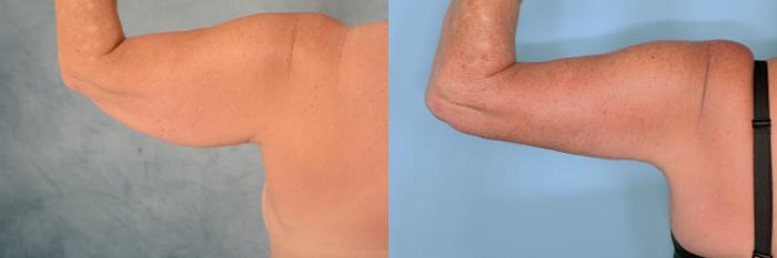 Before & After Arm Lift (Brachioplasty) Case 706 Back View in Tallahassee, FL