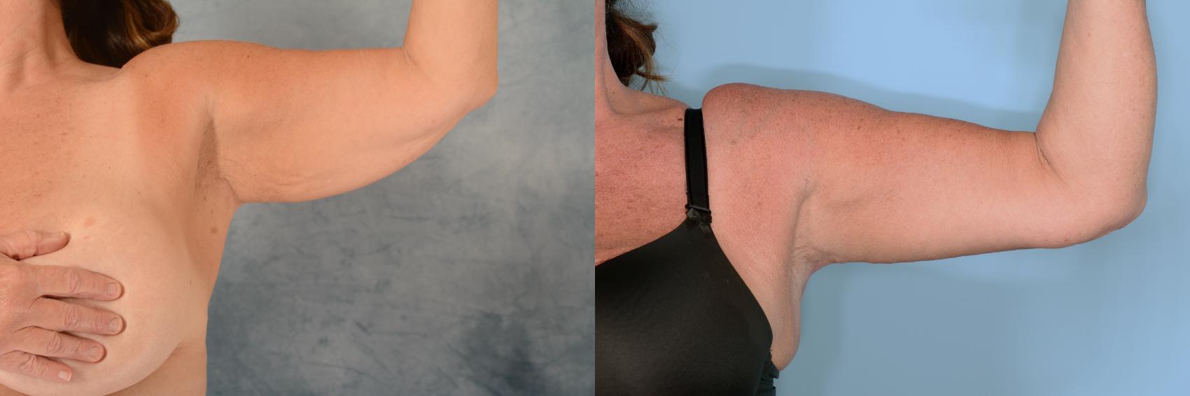 Before & After Arm Lift (Brachioplasty) Case 706 Left Side View in Tallahassee, FL