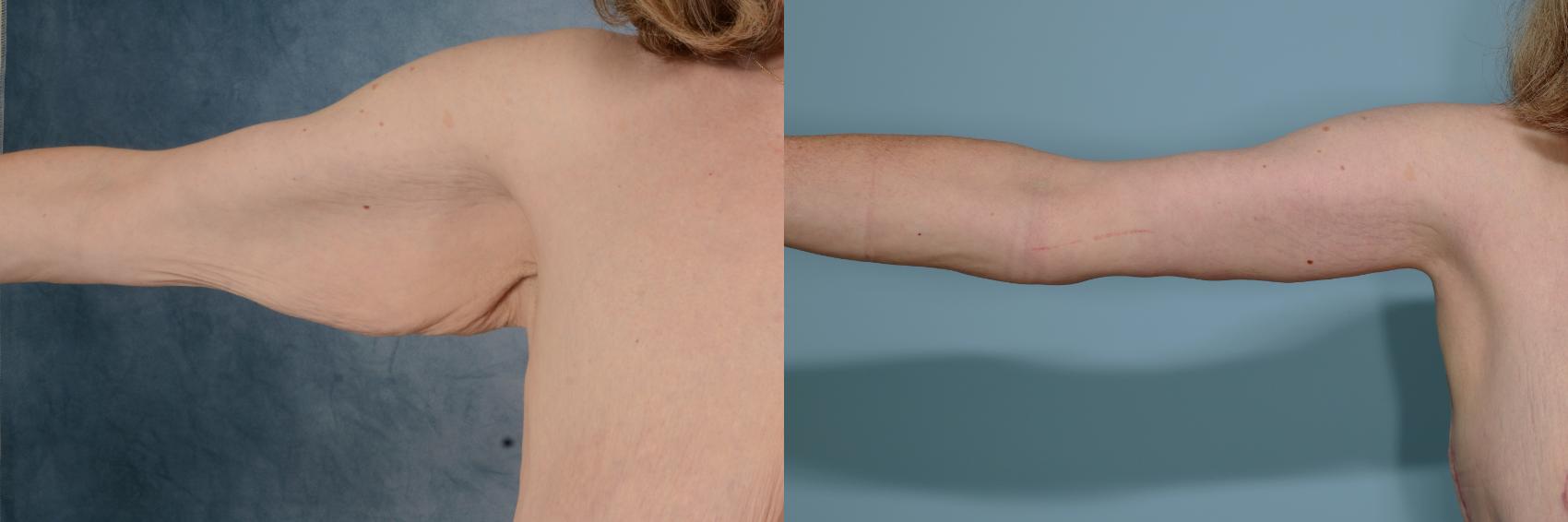 Before & After Arm Lift (Brachioplasty) Case 713 Front View in Tallahassee, FL