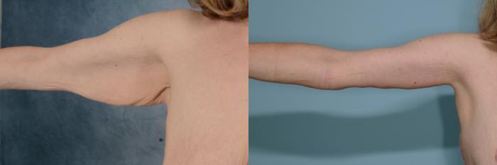 Before & After Arm Lift (Brachioplasty) Case 713 Front View in Tallahassee, FL