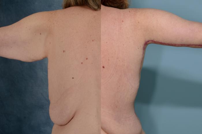 Before & After Arm Lift (Brachioplasty) Case 713 Right Side View in Tallahassee, FL