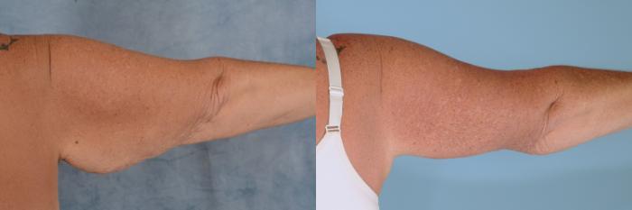 Before & After Arm Lift (Brachioplasty) Case 716 Back View in Tallahassee, FL