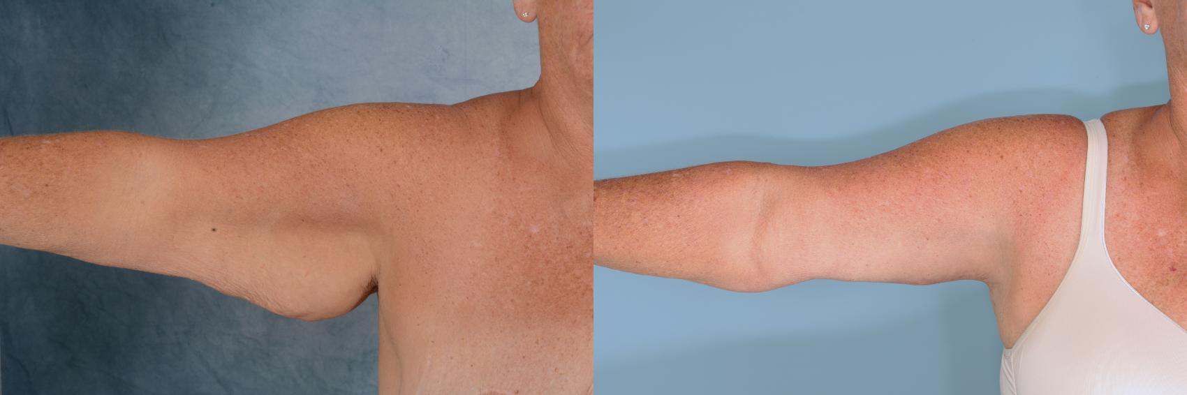 Before & After Arm Lift (Brachioplasty) Case 716 Right Side View in Tallahassee, FL