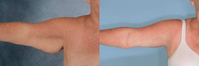 Before & After Arm Lift (Brachioplasty) Case 716 Right Side View in Tallahassee, FL