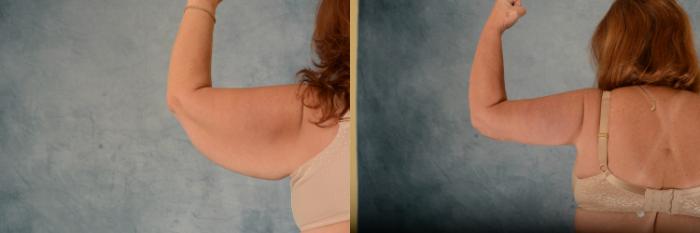 Before & After Arm Lift (Brachioplasty) Case 717 Back View in Tallahassee, FL
