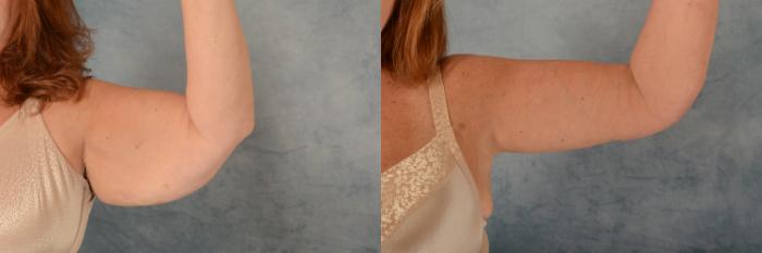Before & After Arm Lift (Brachioplasty) Case 717 Left Side View in Tallahassee, FL