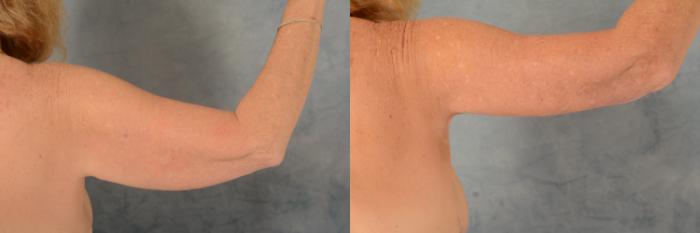 Before & After Arm Lift (Brachioplasty) Case 739 Right Side View in Tallahassee, FL