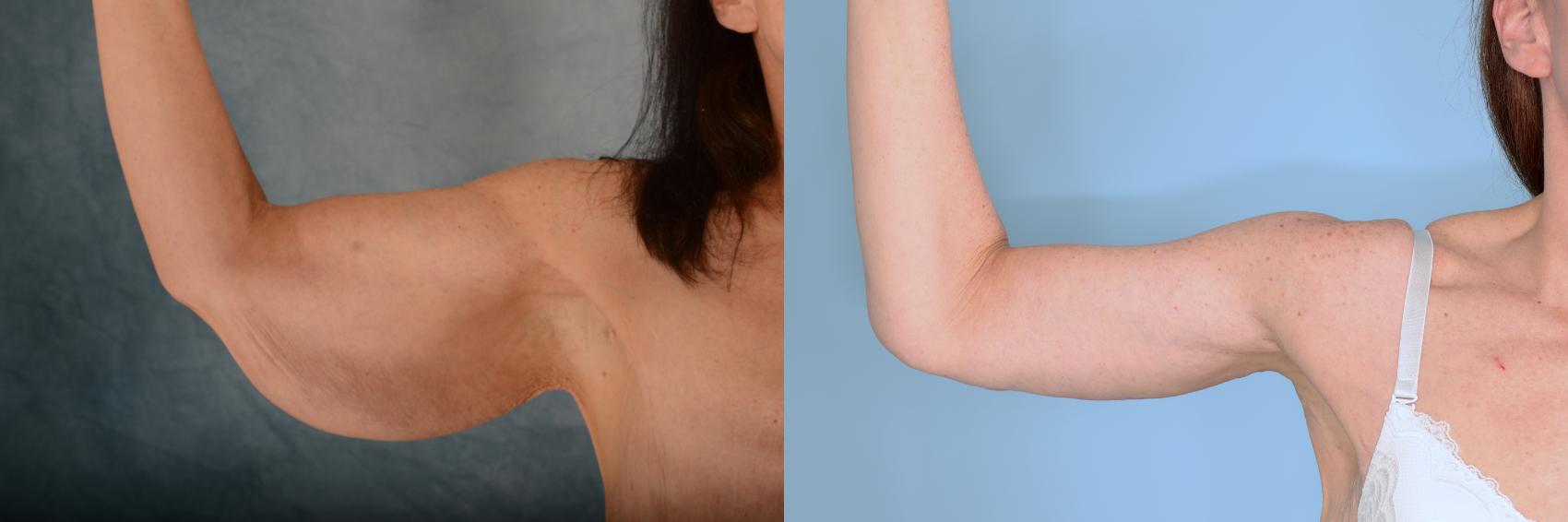 Before & After Arm Lift (Brachioplasty) Case 742 Front View in Tallahassee, FL