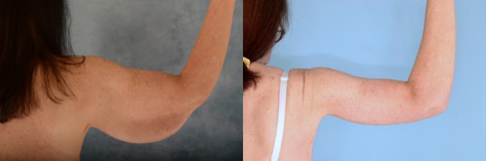 Before & After Arm Lift (Brachioplasty) Case 742 Right Side View in Tallahassee, FL