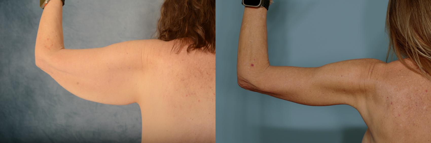 Before & After Arm Lift (Brachioplasty) Case 760 Back View in Tallahassee, FL