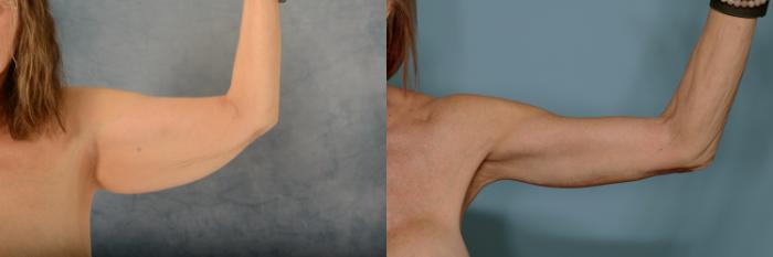 Before & After Arm Lift (Brachioplasty) Case 760 Front View in Tallahassee, FL