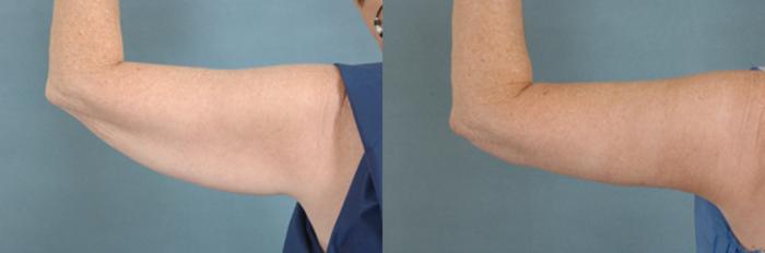 Before & After Arm Lift (Brachioplasty) Case 82 View #1 View in Tallahassee, FL