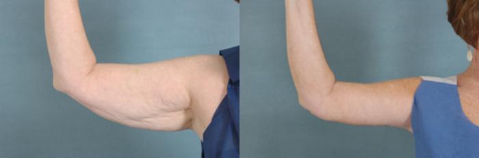 Before & After Arm Lift (Brachioplasty) Case 82 View #2 View in Tallahassee, FL