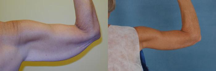 Before & After Arm Lift (Brachioplasty) Case 83 View #1 View in Tallahassee, FL