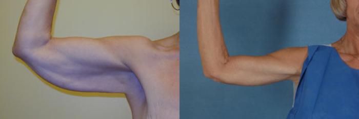 Before & After Arm Lift (Brachioplasty) Case 83 View #2 View in Tallahassee, FL