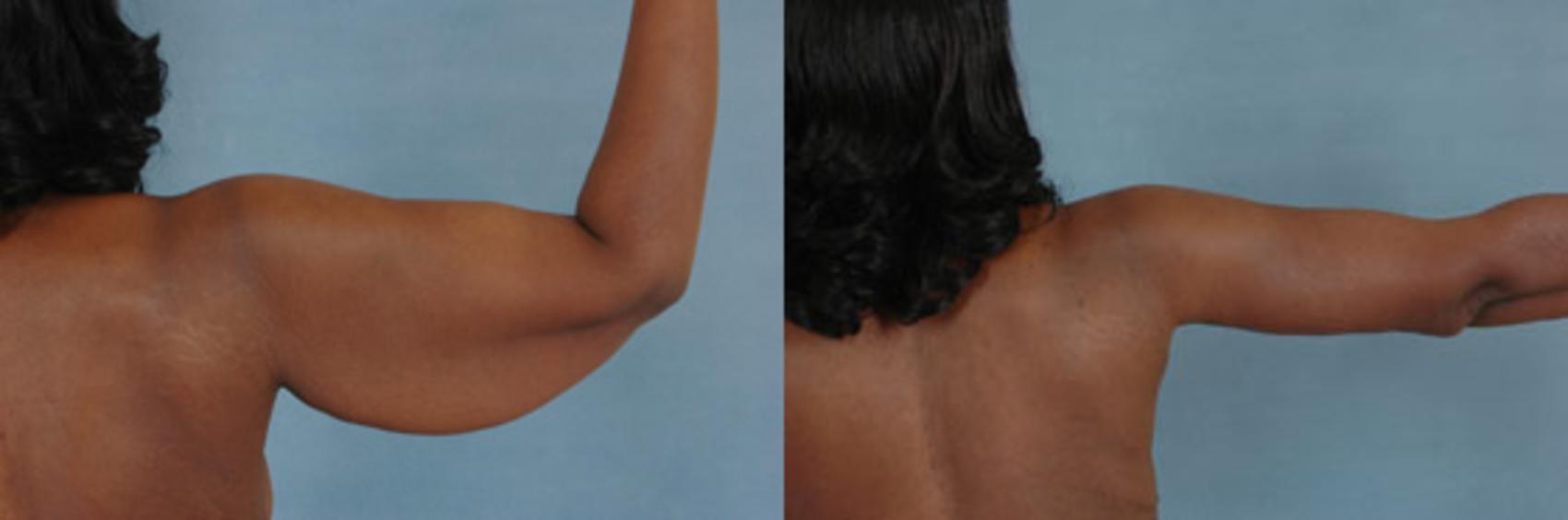 Before & After Arm Lift (Brachioplasty) Case 84 View #1 View in Tallahassee, FL