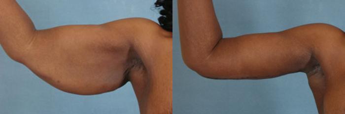 Before & After Arm Lift (Brachioplasty) Case 84 View #2 View in Tallahassee, FL