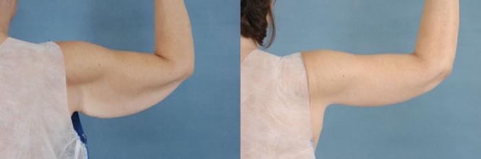 Before & After Arm Lift (Brachioplasty) Case 85 View #1 View in Tallahassee, FL