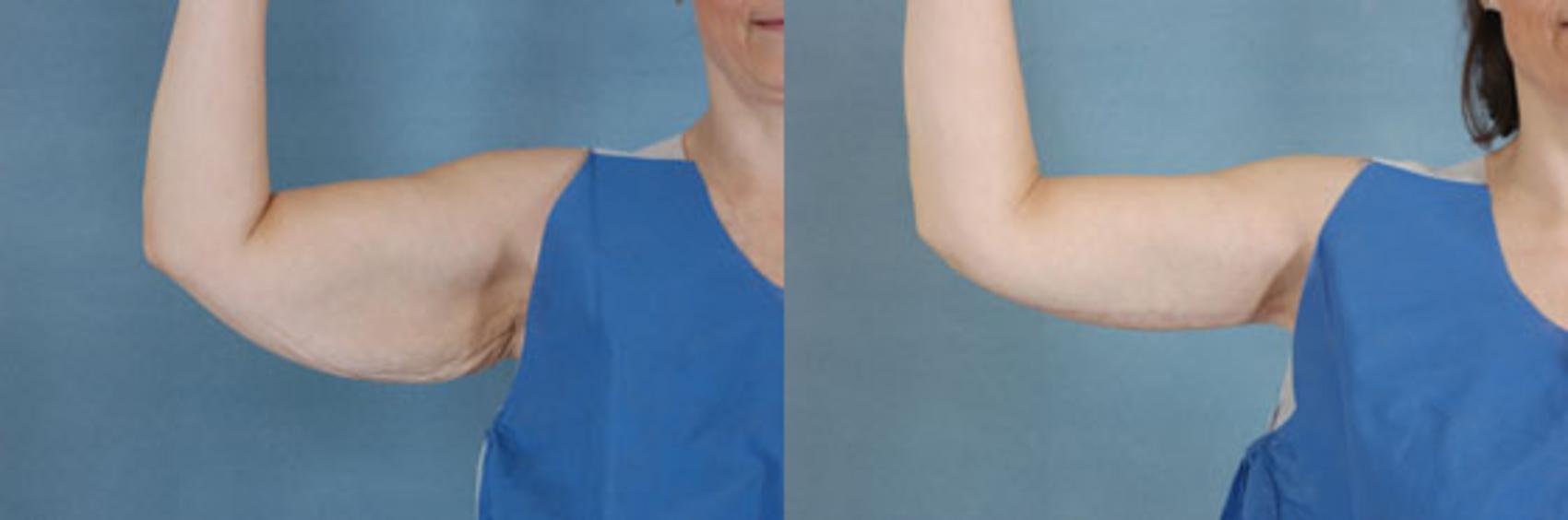 Arm Lift (Brachioplasty) Before and After Pictures Case 85