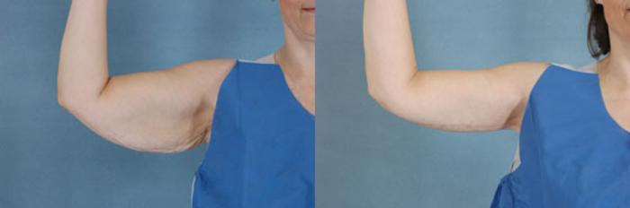 Before & After Arm Lift (Brachioplasty) Case 85 View #2 View in Tallahassee, FL