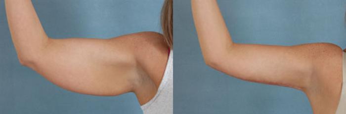 Before & After Arm Lift (Brachioplasty) Case 86 View #1 View in Tallahassee, FL