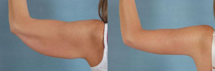 Before & After Arm Lift (Brachioplasty) Case 86 View #2 View in Tallahassee, FL