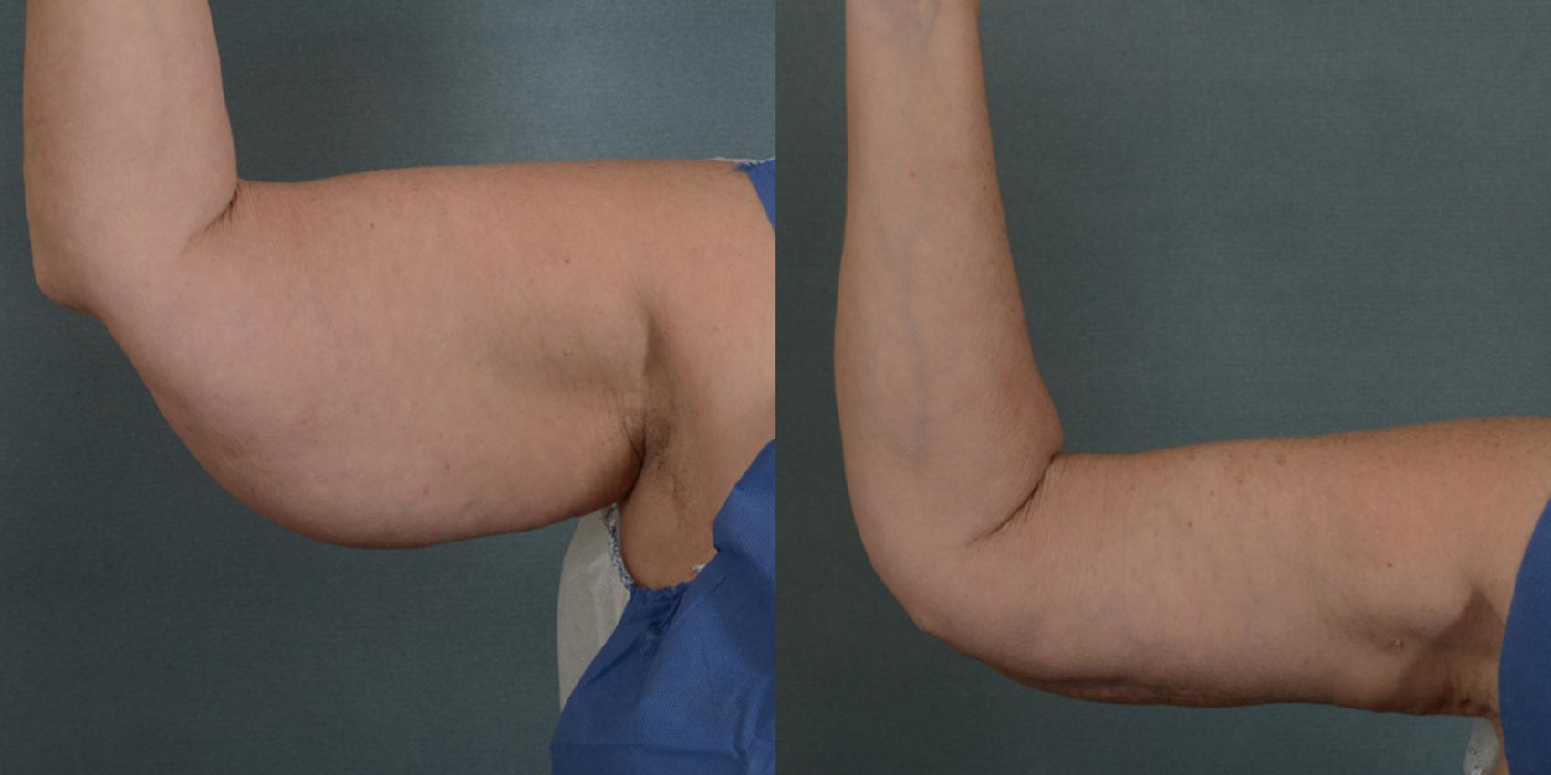 Before & After Arm Lift (Brachioplasty) Case 87 View #1 View in Tallahassee, FL