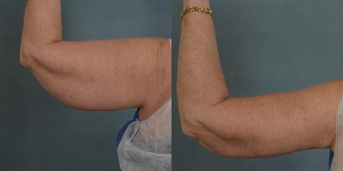 Before & After Arm Lift (Brachioplasty) Case 87 View #2 View in Tallahassee, FL