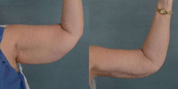 Before & After Arm Lift (Brachioplasty) Case 87 View #3 View in Tallahassee, FL
