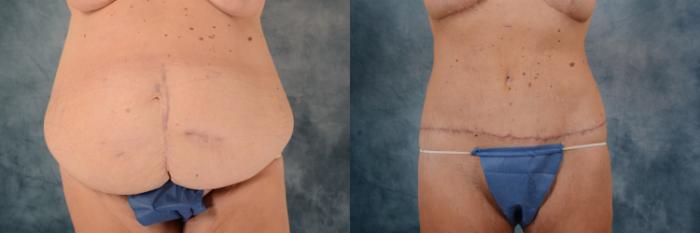 Before & After Body Lift after massive weight loss Case 615 Front View in Tallahassee, FL