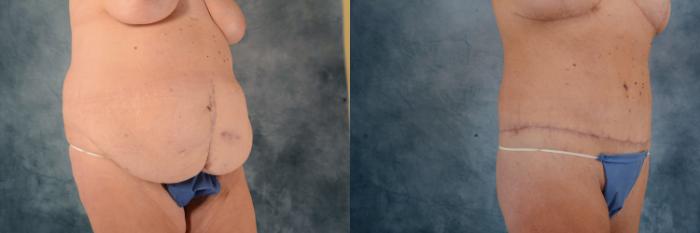 Before & After Body Lift after massive weight loss Case 615 Left Side View in Tallahassee, FL